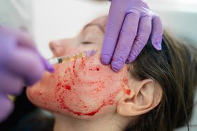 contagios vih facial vampiro